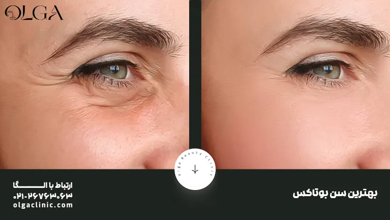 بهترین زمان برای شروع بوتاکس